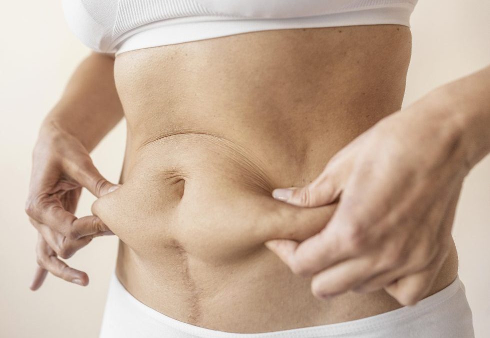 Abdominoplasty / Tummy Tuck in Kenya