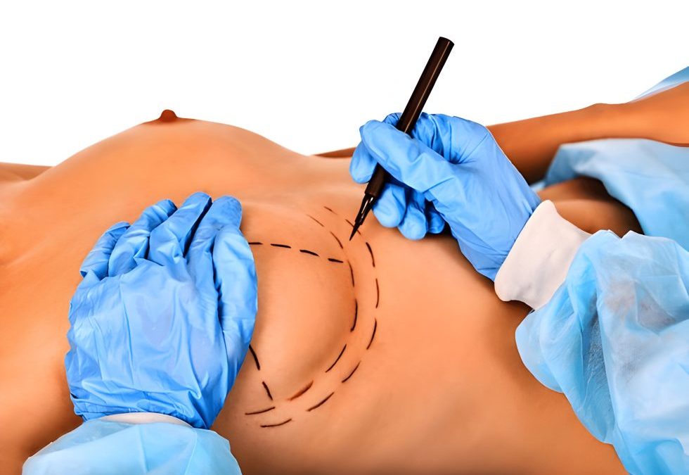 Breast Reduction Surgery in Kenya