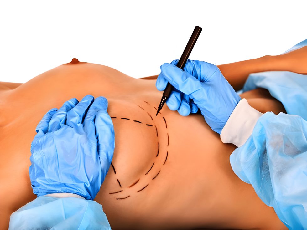 Breast Reduction Surgery in Kenya